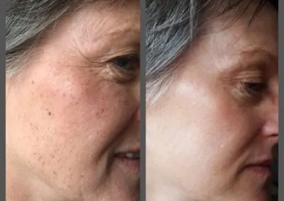 IPL before and after - Soma Laser - Skincare clinic - Pretoria - Customised skin and hair treatments. Stockists of Dermalogica, Lamelle, MD Lash Factor and Heliocare