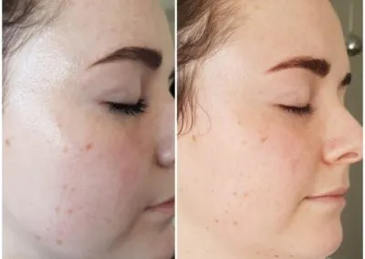 IPL before and after - Soma Laser - Skincare clinic - Pretoria - Customised skin and hair treatments. Stockists of Dermalogica, Lamelle, MD Lash Factor and Heliocare