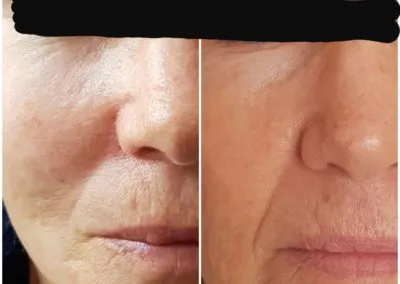 IPL before and after - Soma Laser - Skincare clinic - Pretoria - Customised skin and hair treatments. Stockists of Dermalogica, Lamelle, MD Lash Factor and Heliocare