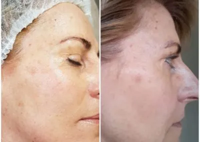 IPL before and after - Soma Laser - Skincare clinic - Pretoria - Customised skin and hair treatments. Stockists of Dermalogica, Lamelle, MD Lash Factor and Heliocare