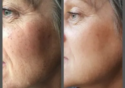 IPL before and after - Soma Laser - Skincare clinic - Pretoria - Customised skin and hair treatments. Stockists of Dermalogica, Lamelle, MD Lash Factor and Heliocare