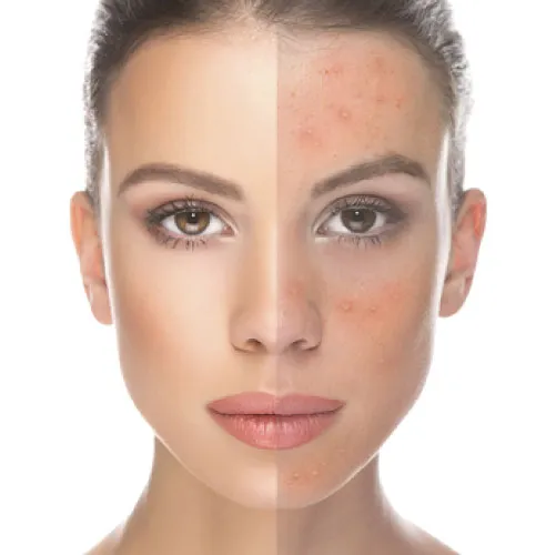 Acne Scarring