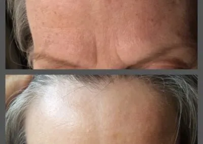 IPL before and after - Soma Laser - Skincare clinic - Pretoria - Customised skin and hair treatments. Stockists of Dermalogica, Lamelle, MD Lash Factor and Heliocare