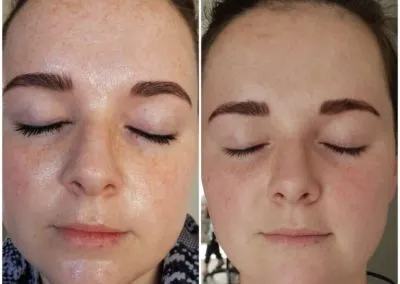 IPL before and after - Soma Laser - Skincare clinic - Pretoria - Customised skin and hair treatments. Stockists of Dermalogica, Lamelle, MD Lash Factor and Heliocare