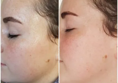 IPL before and after - Soma Laser - Skincare clinic - Pretoria - Customised skin and hair treatments. Stockists of Dermalogica, Lamelle, MD Lash Factor and Heliocare