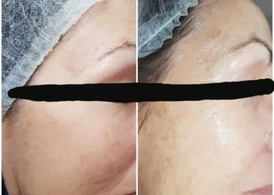 IPL before and after - Soma Laser - Skincare clinic - Pretoria - Customised skin and hair treatments. Stockists of Dermalogica, Lamelle, MD Lash Factor and Heliocare