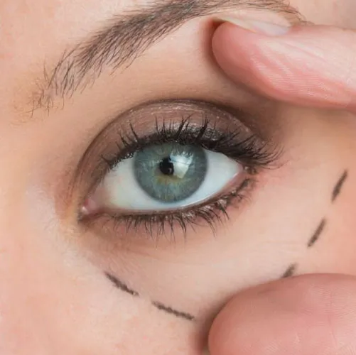 Eyes: Lines & Wrinkles