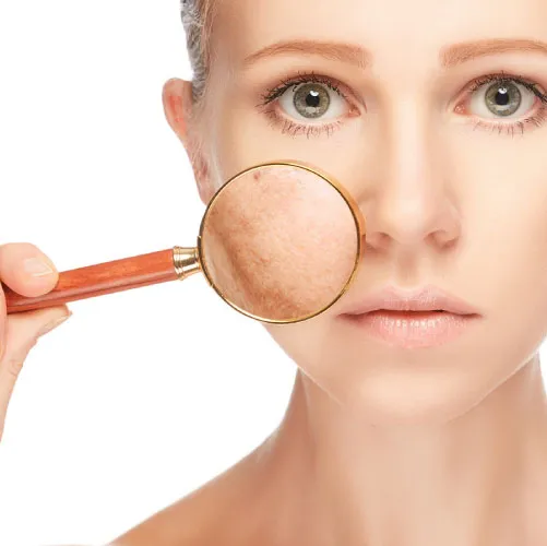 Pigmentation: Hormonal / Large Patches