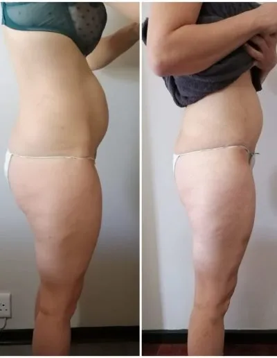 1 Fat Freeze - Soma Laser - Skincare clinic - Pretoria - Customised skin and hair treatments. Stockists of Dermalogica, Lamelle, MD Lash Factor and Heliocare