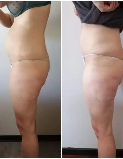 2 Fat Freeze - Soma Laser - Skincare clinic - Pretoria - Customised skin and hair treatments. Stockists of Dermalogica, Lamelle, MD Lash Factor and Heliocare