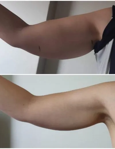 3 Fat Freeze - Soma Laser - Skincare clinic - Pretoria - Customised skin and hair treatments. Stockists of Dermalogica, Lamelle, MD Lash Factor and Heliocare