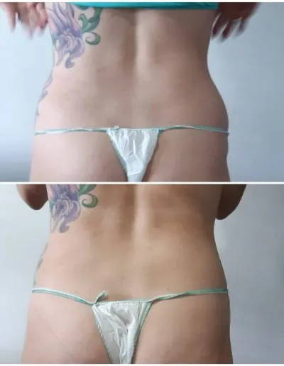 4 Fat Freeze - Soma Laser - Skincare clinic - Pretoria - Customised skin and hair treatments. Stockists of Dermalogica, Lamelle, MD Lash Factor and Heliocare