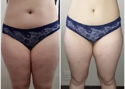 5 Fat Freeze - Soma Laser - Skincare clinic - Pretoria - Customised skin and hair treatments. Stockists of Dermalogica, Lamelle, MD Lash Factor and Heliocare