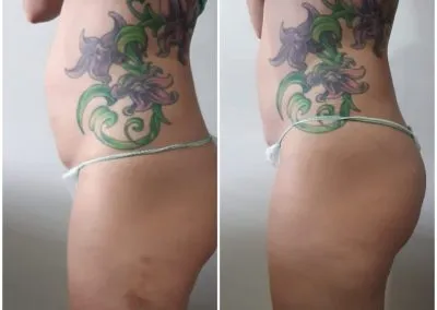 6 Fat Freeze - Soma Laser - Skincare clinic - Pretoria - Customised skin and hair treatments. Stockists of Dermalogica, Lamelle, MD Lash Factor and Heliocare