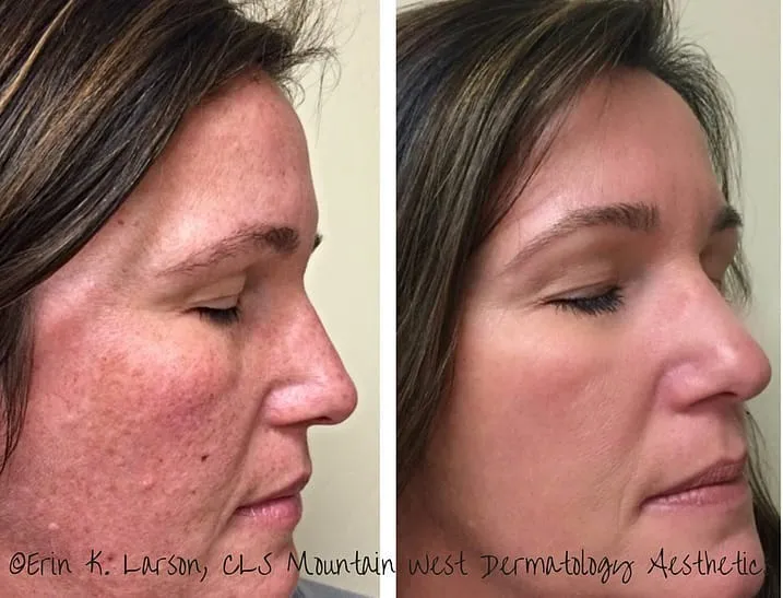 Soma Laser - ClearLift - Lunchtime Facelift