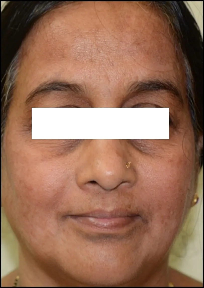 Melasma