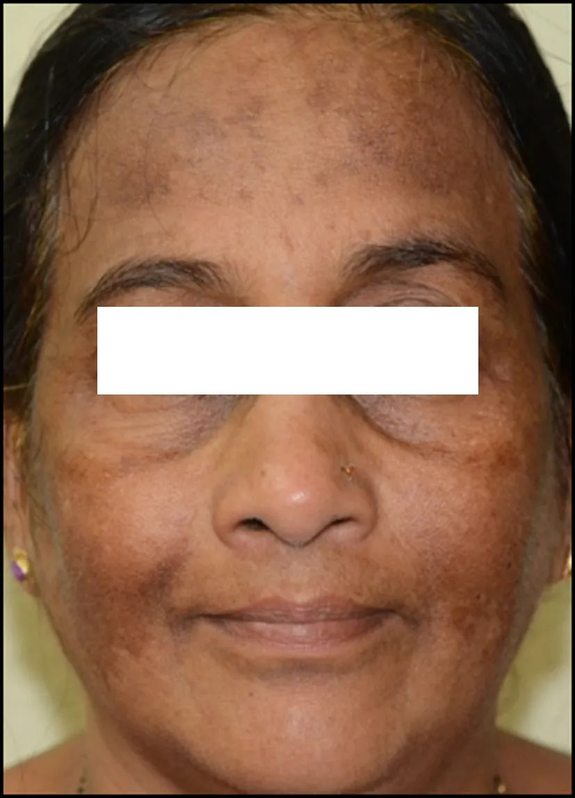 Melasma
