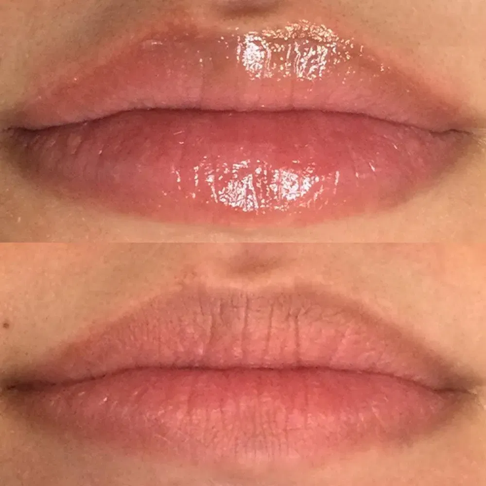 Soma Laser - Laser Lip Plumping