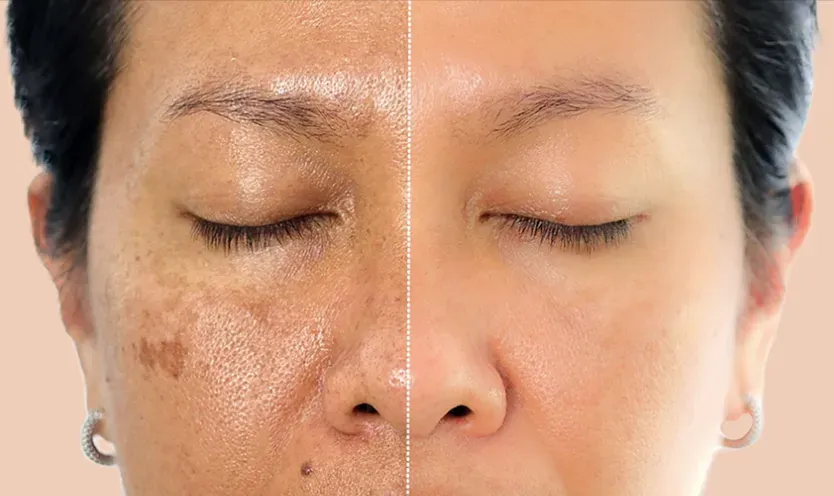 Understanding Melasma and How Soma Laser & Skincare Clinic Can Help