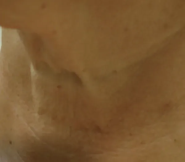 Lunchtime Facelift - Clearlift