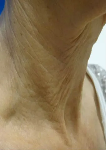 Lunchtime Facelift - Clearlift