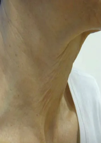 Lunchtime Facelift - Clearlift