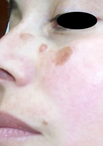 Lunchtime Facelift - Clearlift