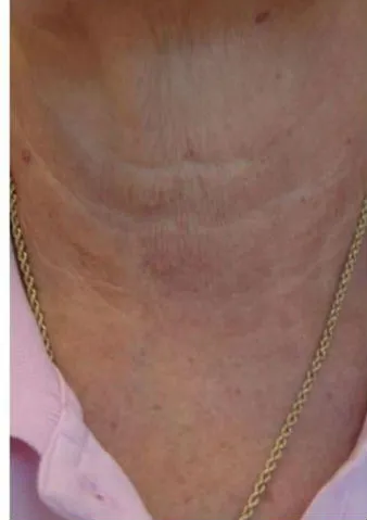 Lunchtime Facelift - Clearlift