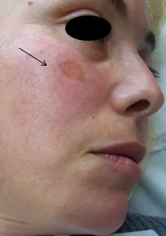 Lunchtime Facelift - Clearlift