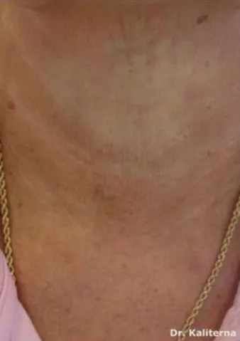 Lunchtime Facelift - Clearlift