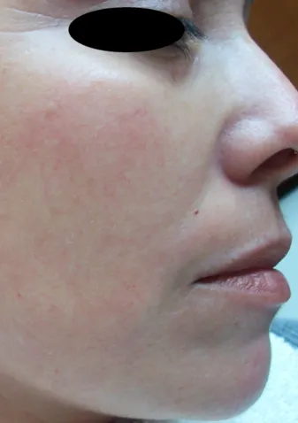 Lunchtime Facelift - Clearlift