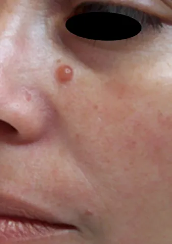 Lunchtime Facelift - Clearlift