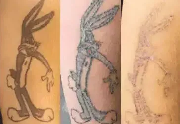 about tattoo removal