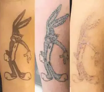 about tattoo removal